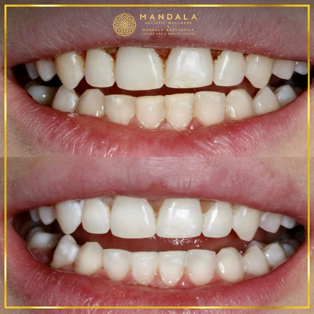 Teeth whitening before and after results showing a visibly white teeth,  brighter-looking smile at Mandala Aesthetics in Preston, Melbourne.