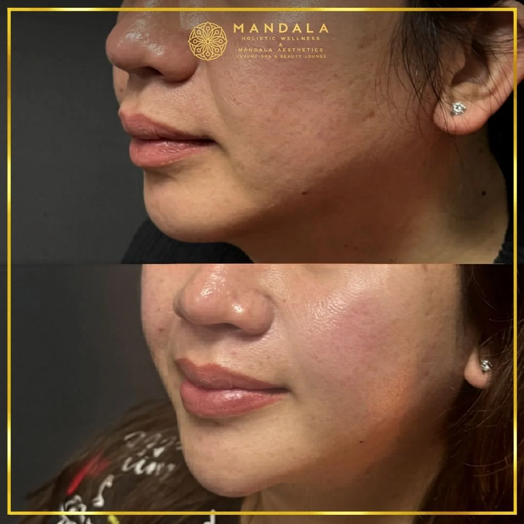 HIFU before and after results showing the lower face, chin and jawline at Mandala Aesthetics in Preston, Melbourne.