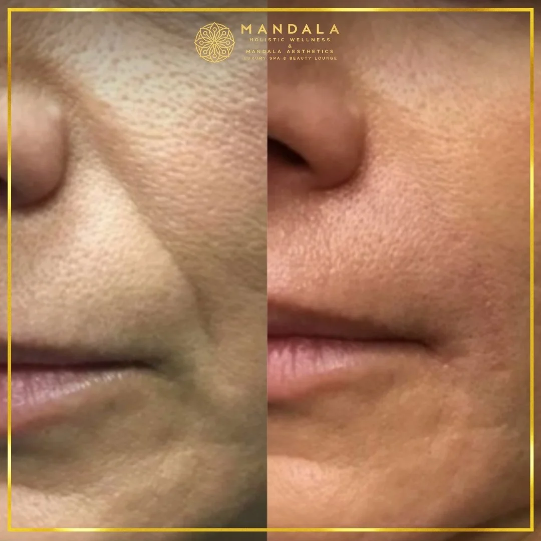 RF Microneedling before and after results showing improved-looking skin texture  and acne scars at Mandala Aesthetics in Preston, Melbourne.
