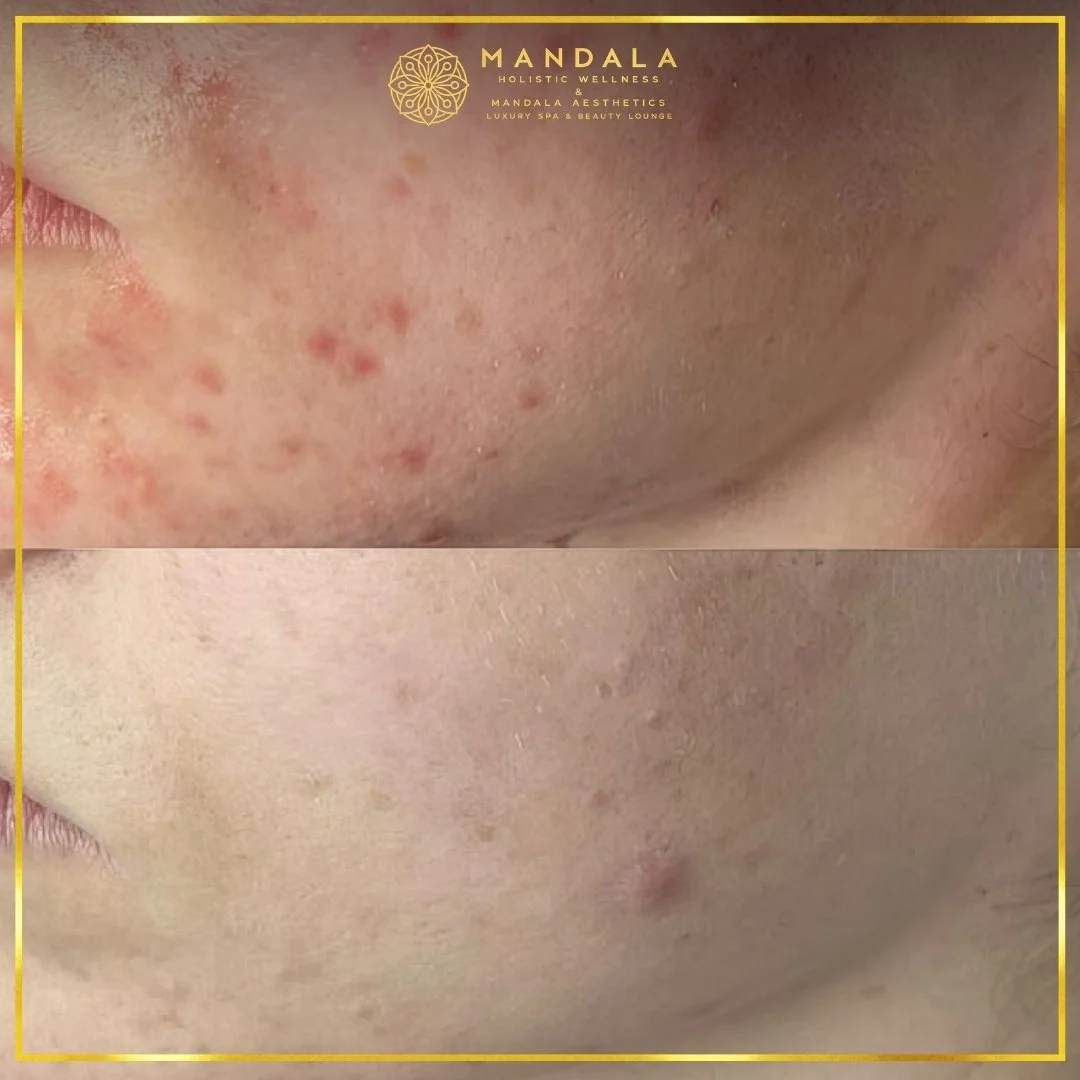 Facial treatment before and after results showing refreshed, hydrated and glowing-looking skin at Mandala Aesthetics in Preston, Melbourne.