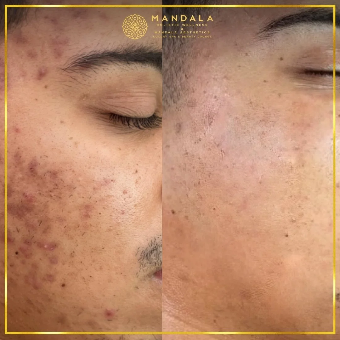 Facial treatment before and after results showing refreshed, hydrated and glowing-looking skin at Mandala Aesthetics in Preston, Melbourne.