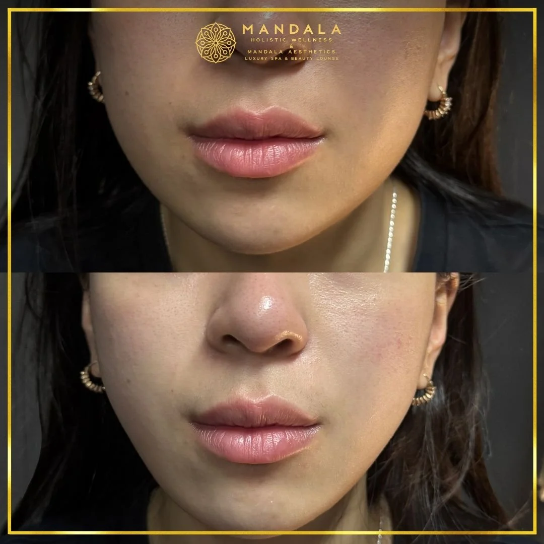 HIFU before and after results showing the lower face, chin and jawline at Mandala Aesthetics in Preston, Melbourne.