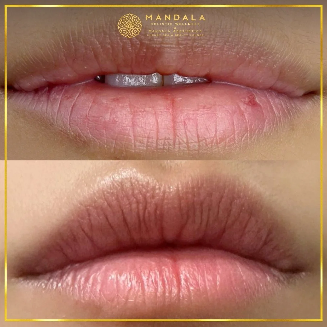 RomaPink Lip Treatment before and after results showing a more even, hydrated lips and naturally pink-looking lip tone at Mandala Aesthetics in Preston, Melbourne.