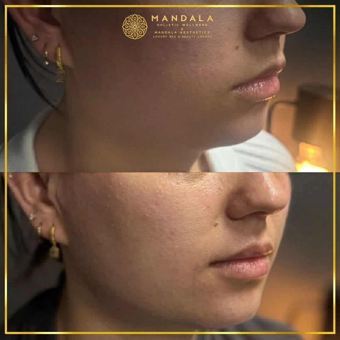HIFU before and after results showing the lower face, chin and jawline at Mandala Aesthetics in Preston, Melbourne.