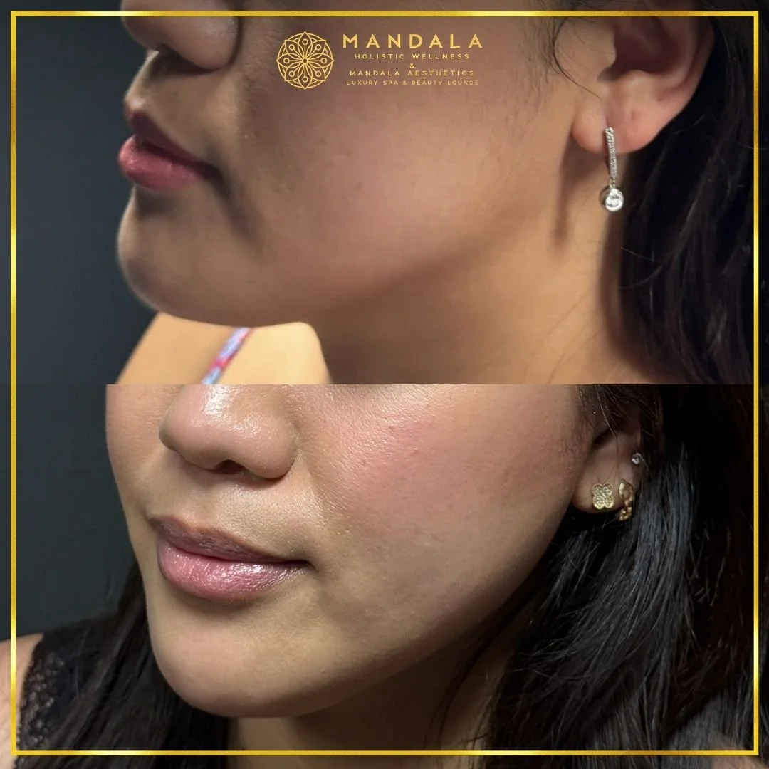 HIFU before and after results showing the lower face, chin and jawline at Mandala Aesthetics in Preston, Melbourne.