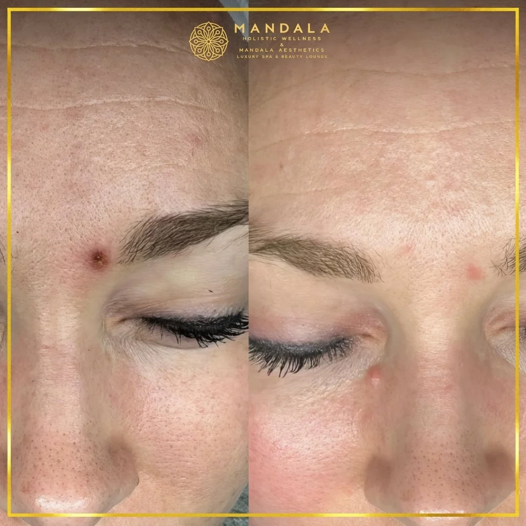 RF Microneedling before and after results showing improved-looking skin texture  and acne scars at Mandala Aesthetics in Preston, Melbourne.