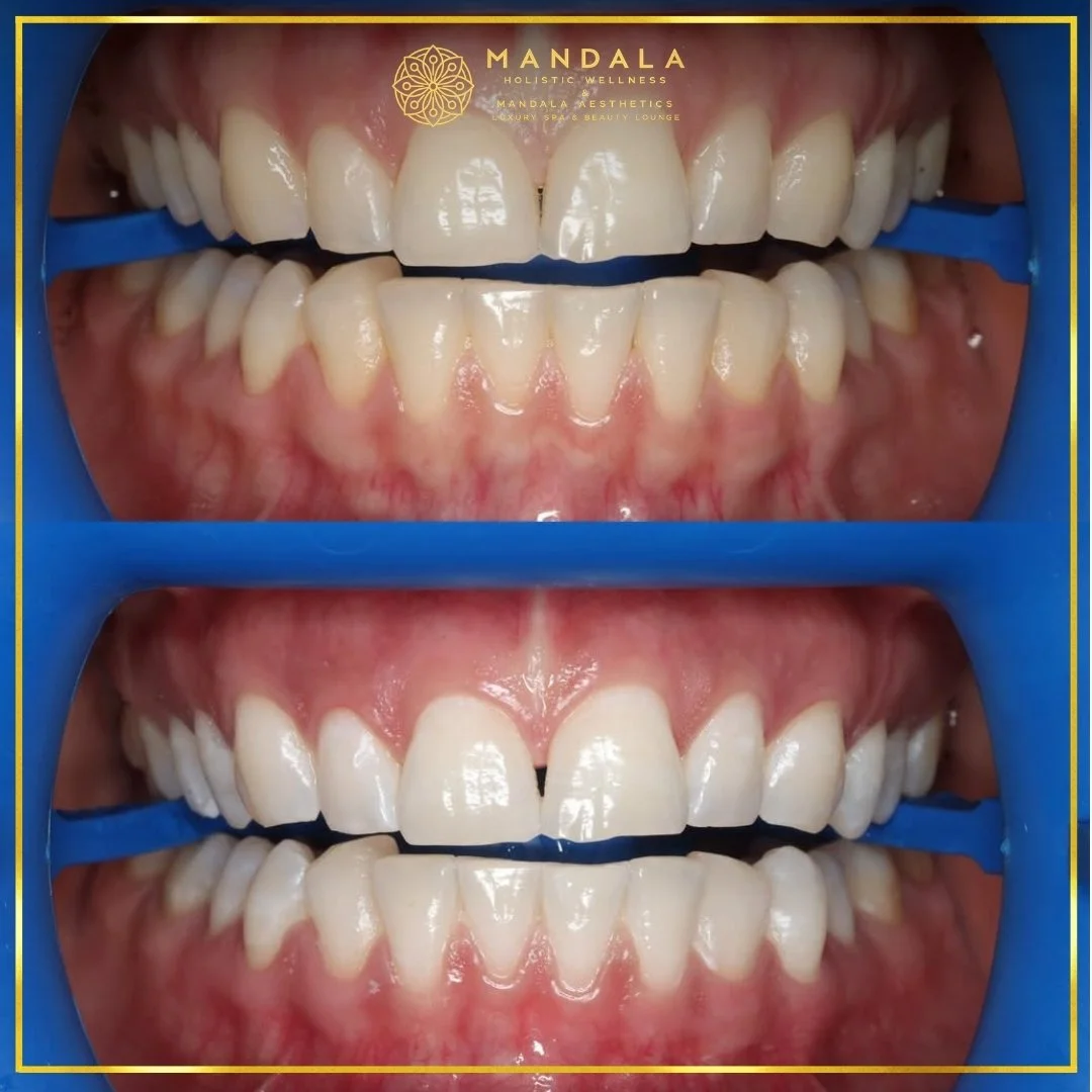Teeth whitening before and after results showing a visibly white teeth,  brighter-looking smile at Mandala Aesthetics in Preston, Melbourne.