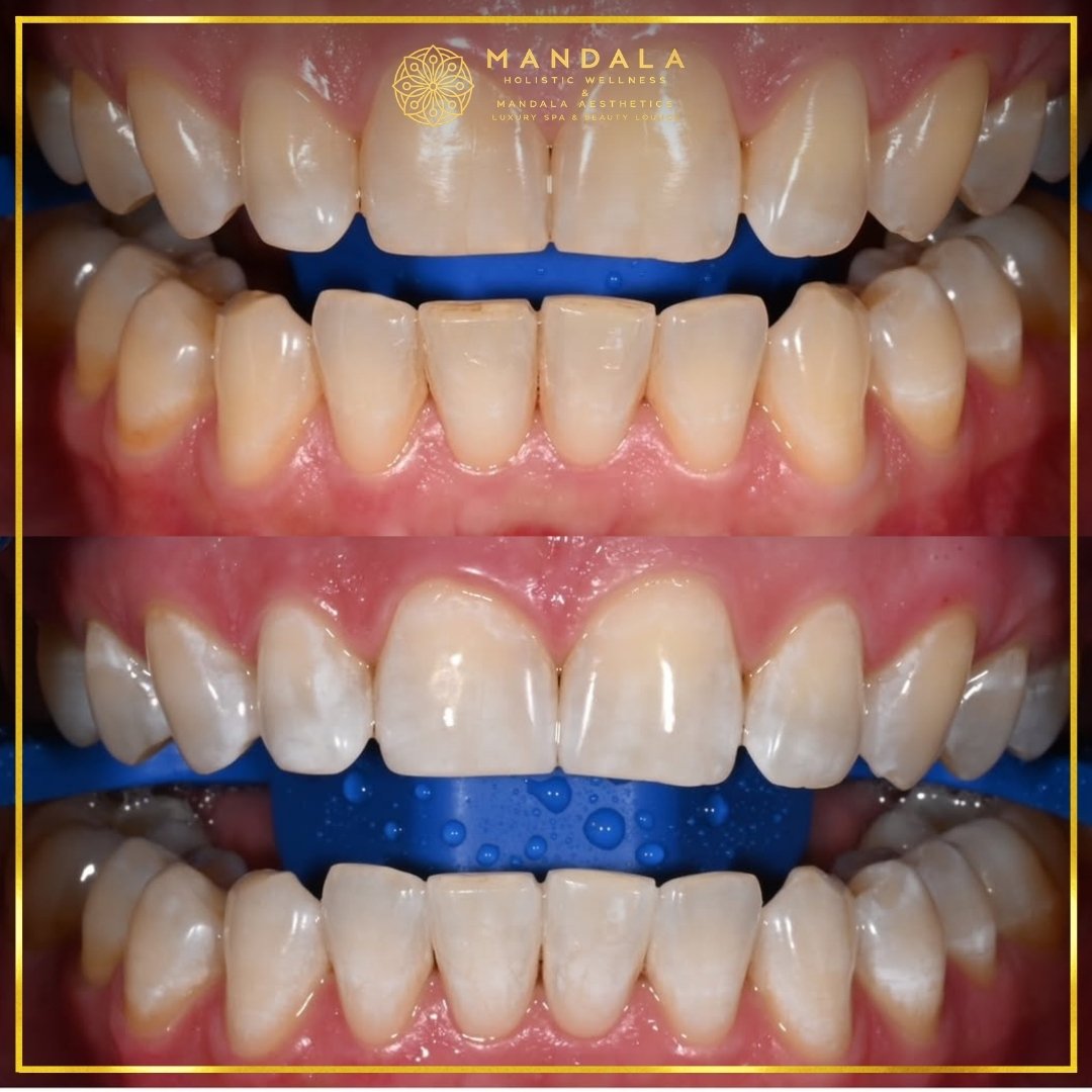 Teeth whitening before and after results showing a visibly white teeth,  brighter-looking smile at Mandala Aesthetics in Preston, Melbourne.