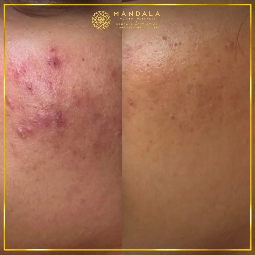 Facial treatment before and after results showing refreshed, hydrated and glowing-looking skin at Mandala Aesthetics in Preston, Melbourne.