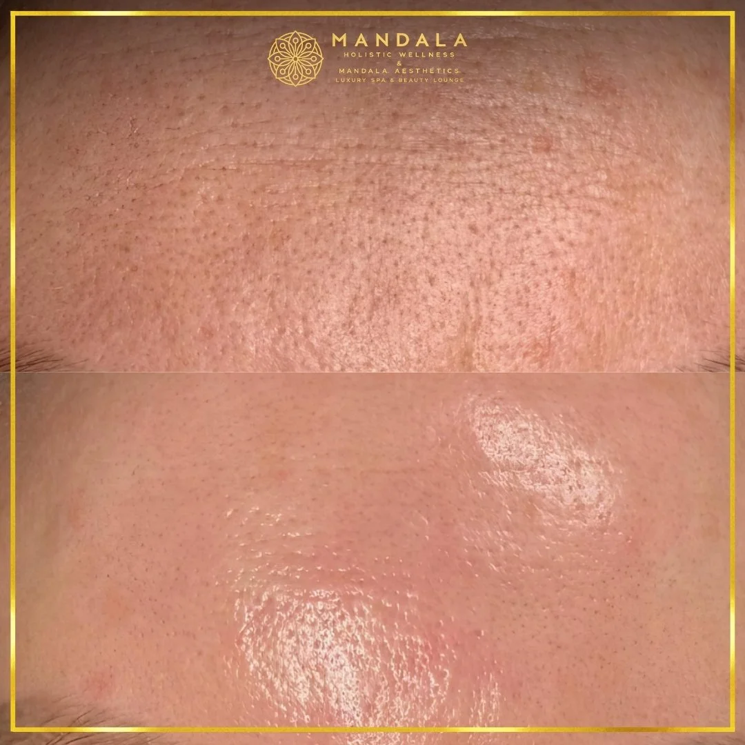 RF Microneedling before and after results showing improved-looking skin texture  and acne scars at Mandala Aesthetics in Preston, Melbourne.
