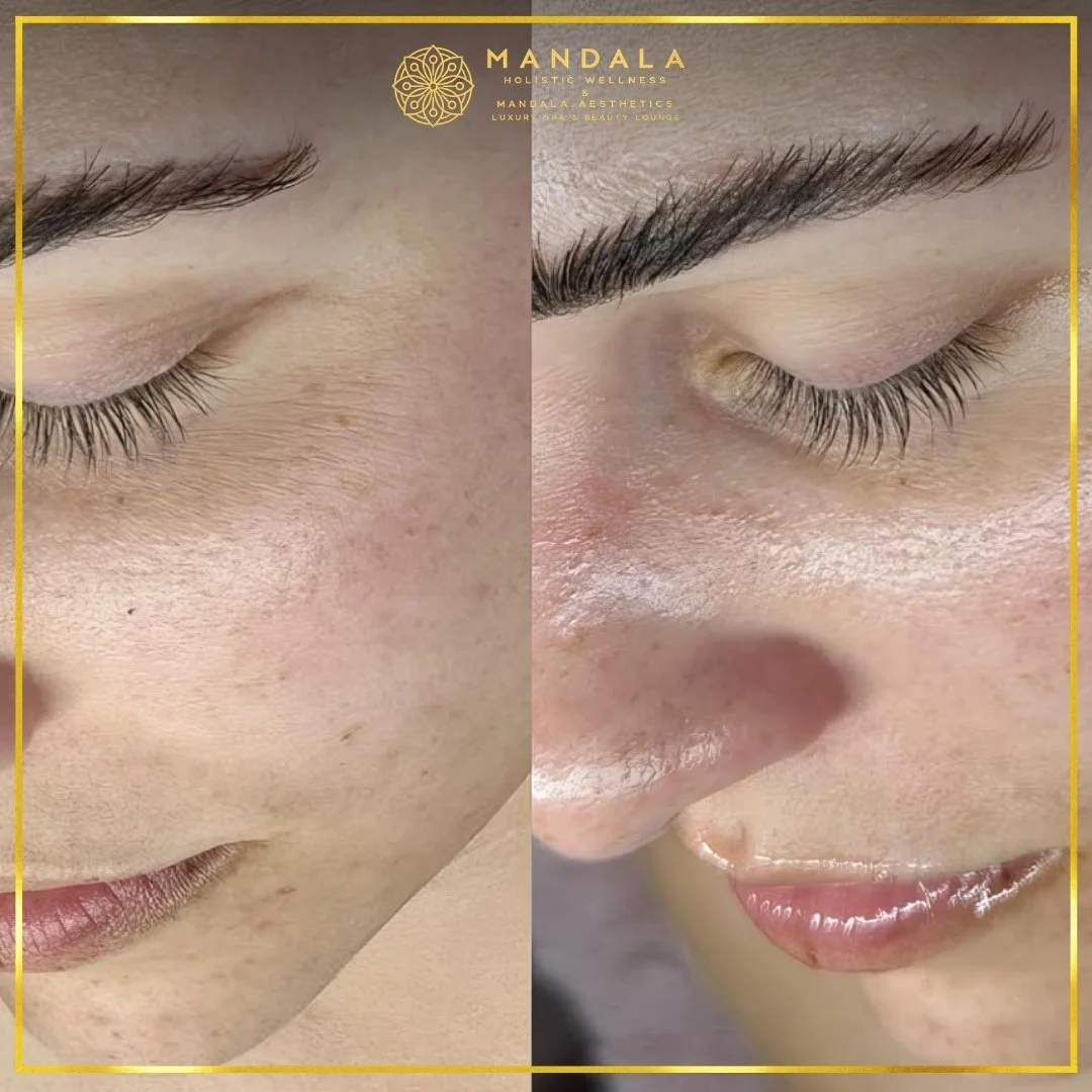 Facial treatment before and after results showing refreshed, hydrated and glowing-looking skin at Mandala Aesthetics in Preston, Melbourne.