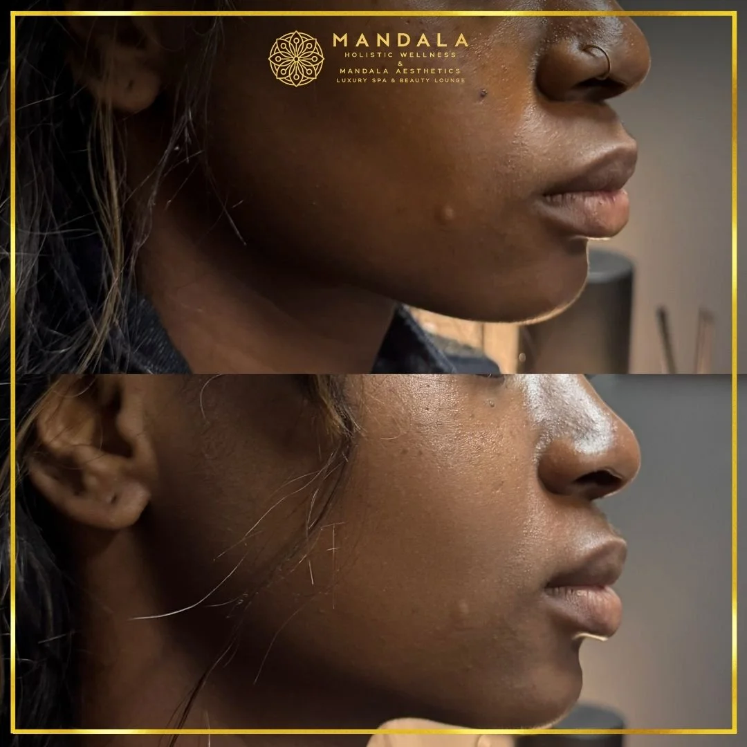 HIFU before and after results showing the lower face, chin and jawline at Mandala Aesthetics in Preston, Melbourne.