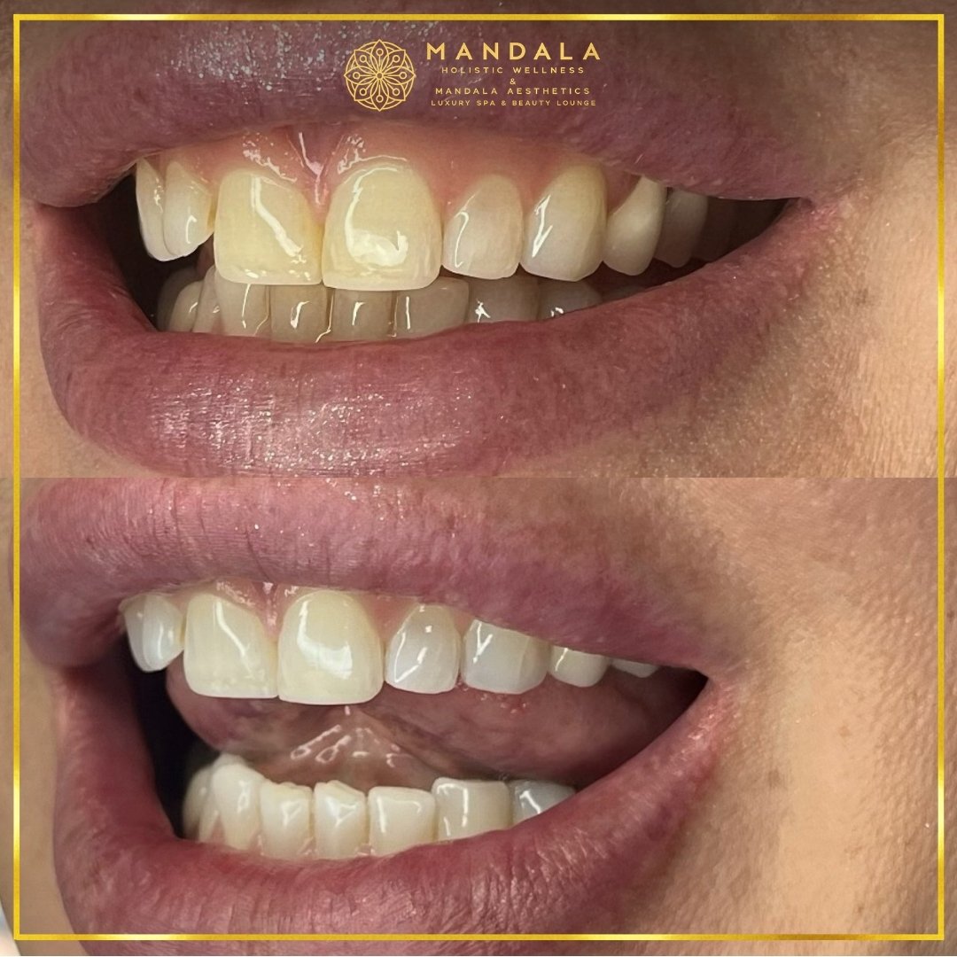 Teeth whitening before and after results showing a visibly white teeth,  brighter-looking smile at Mandala Aesthetics in Preston, Melbourne.