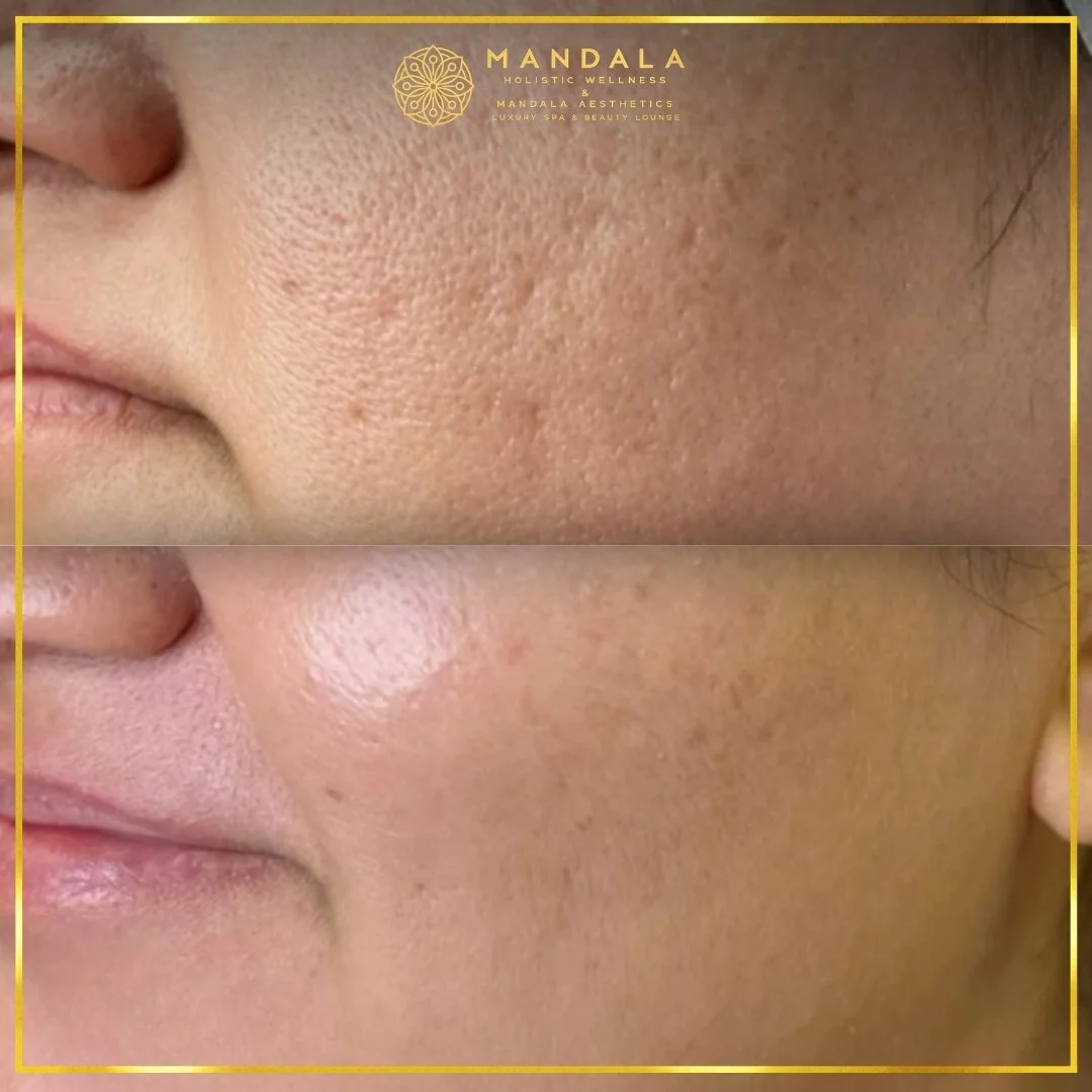 RF Microneedling before and after results showing improved-looking skin texture  and acne scars at Mandala Aesthetics in Preston, Melbourne.