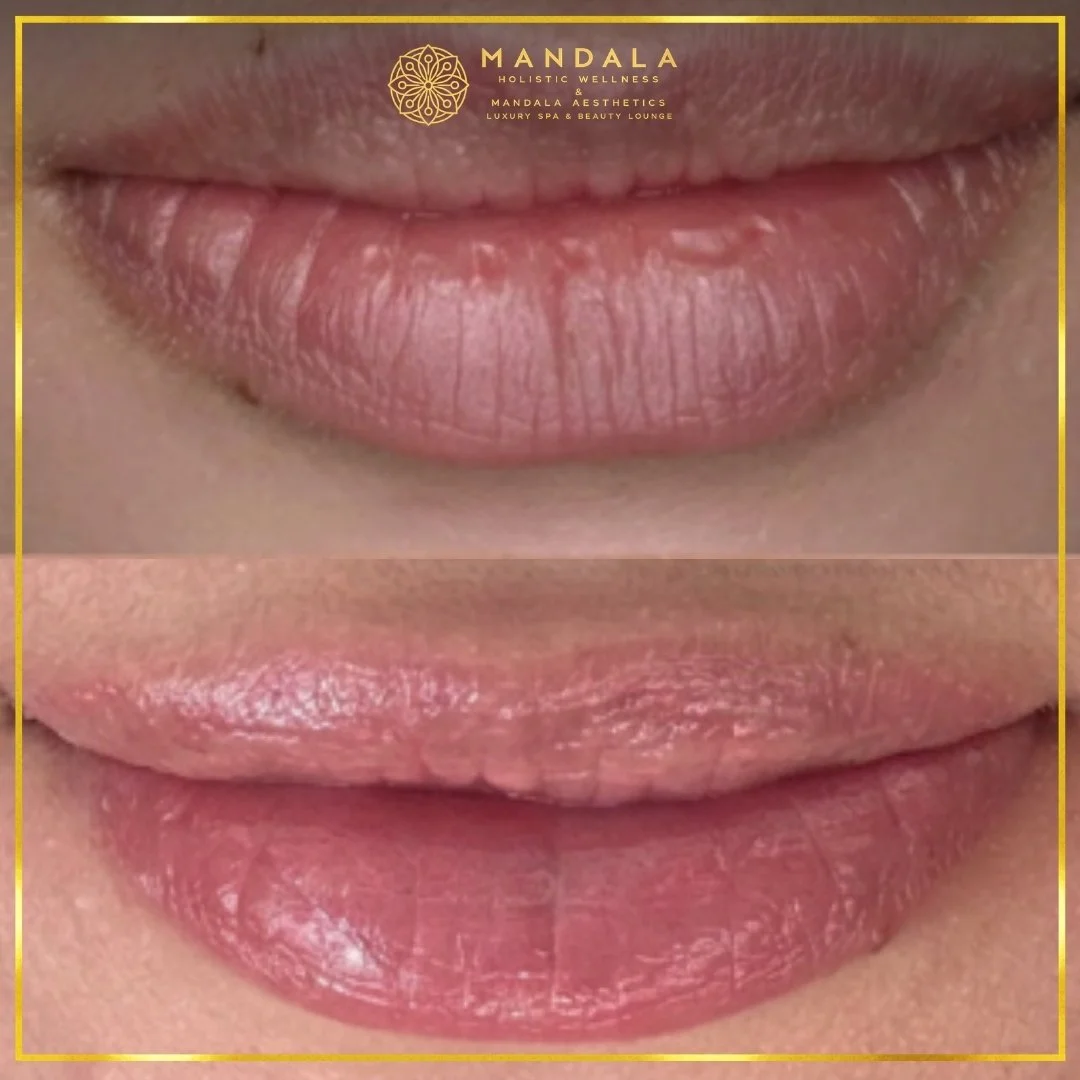 RomaPink Lip Treatment before and after results showing a more even, hydrated lips and naturally pink-looking lip tone at Mandala Aesthetics in Preston, Melbourne.