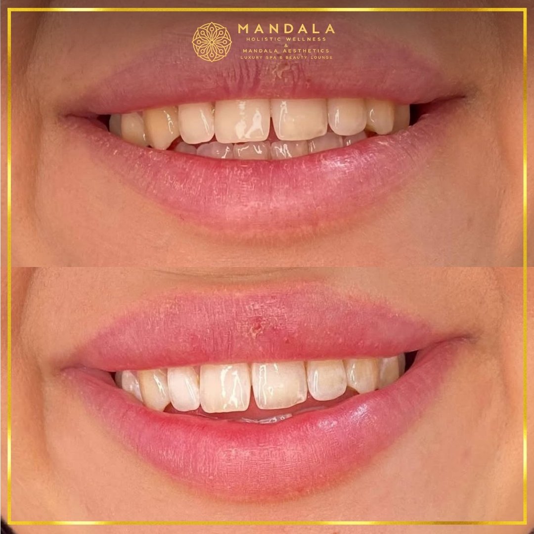 Teeth whitening before and after results showing a visibly white teeth,  brighter-looking smile at Mandala Aesthetics in Preston, Melbourne.