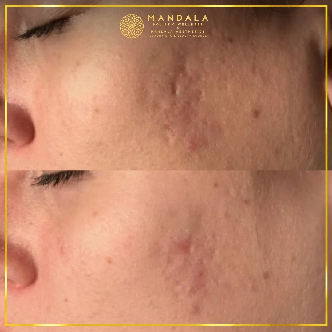RF Microneedling before and after results showing improved-looking skin texture  and acne scars at Mandala Aesthetics in Preston, Melbourne.
