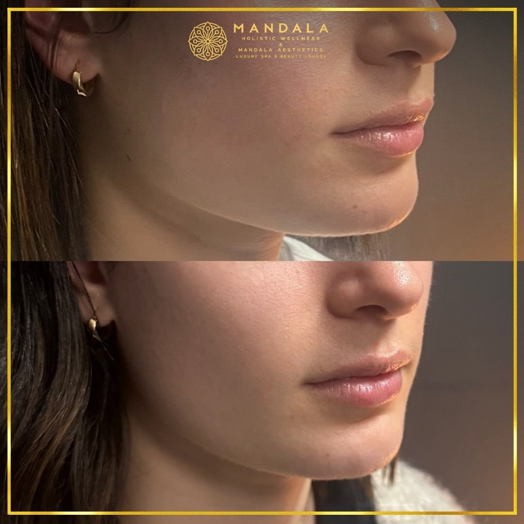 HIFU before and after results showing the lower face, chin and jawline at Mandala Aesthetics in Preston, Melbourne.