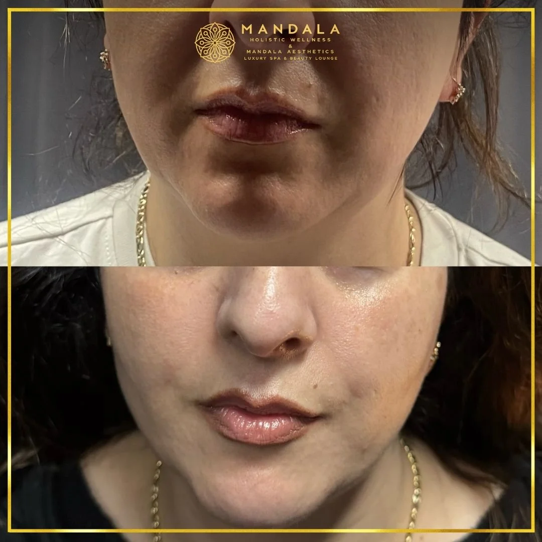 HIFU before and after results showing the lower face, chin and jawline at Mandala Aesthetics in Preston, Melbourne.