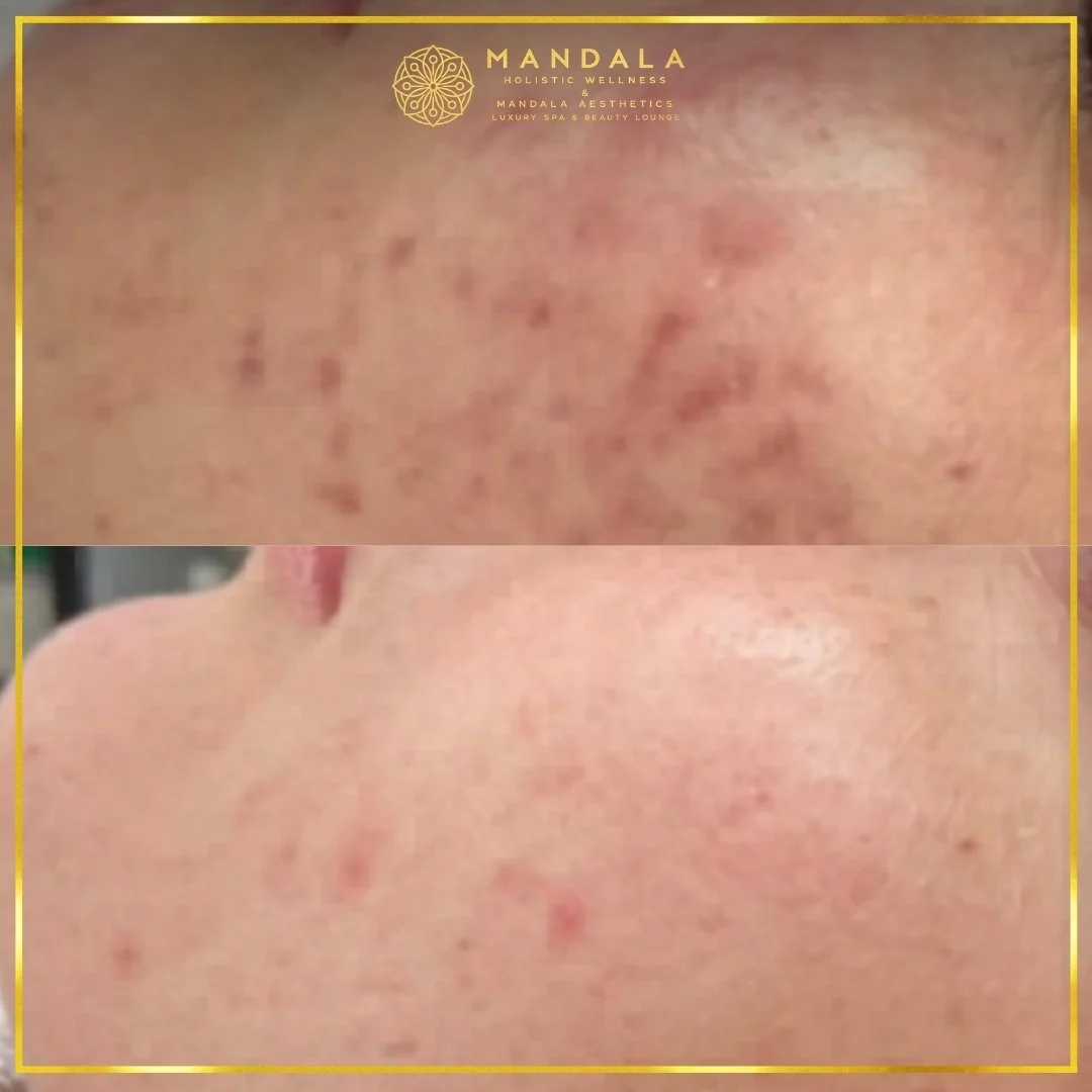 Facial treatment before and after results showing refreshed, hydrated and glowing-looking skin at Mandala Aesthetics in Preston, Melbourne.