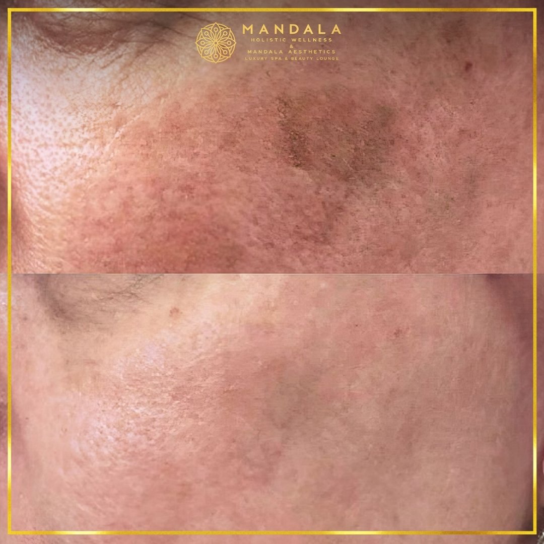WhiteLab Spot Melanin Removal before and after results showing the appearance of age spots, sun spots , freckles, melasma, pigmentation at Mandala Aesthetics in Preston, Melbourne.