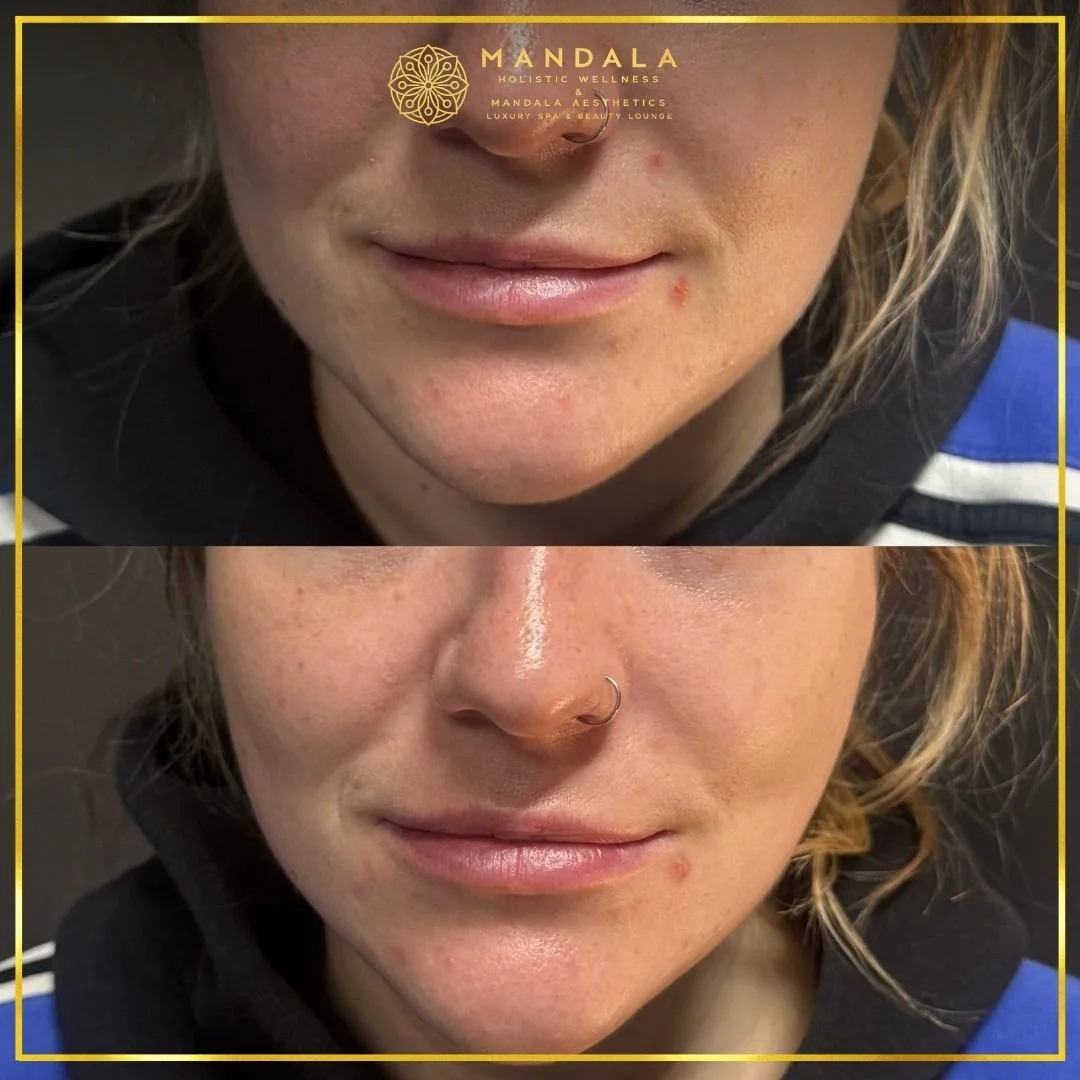 HIFU before and after results showing the lower face, chin and jawline at Mandala Aesthetics in Preston, Melbourne.