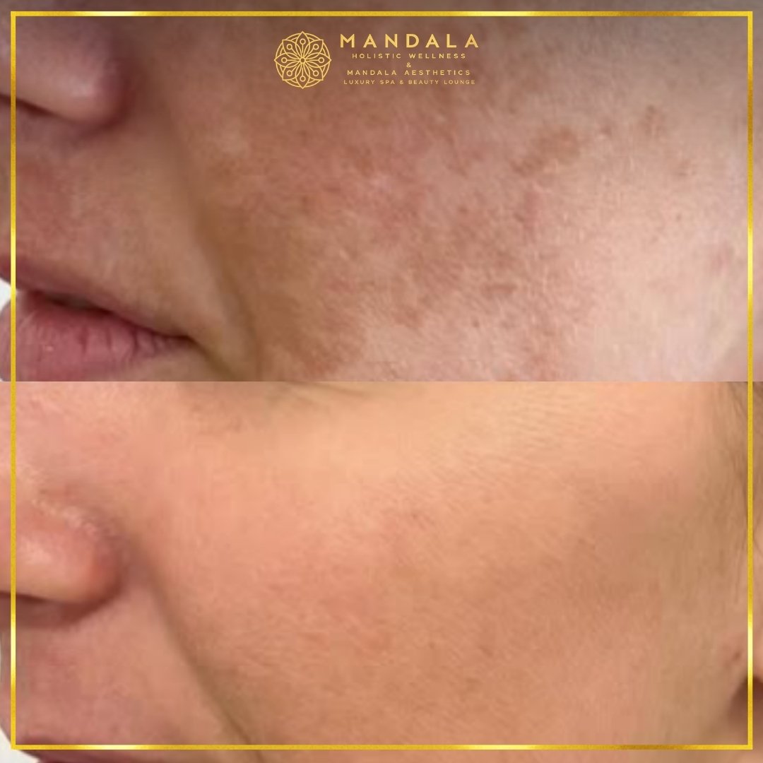 WhiteLab Spot Melanin Removal before and after results showing the appearance of age spots, sun spots , freckles, melasma, pigmentation at Mandala Aesthetics in Preston, Melbourne.