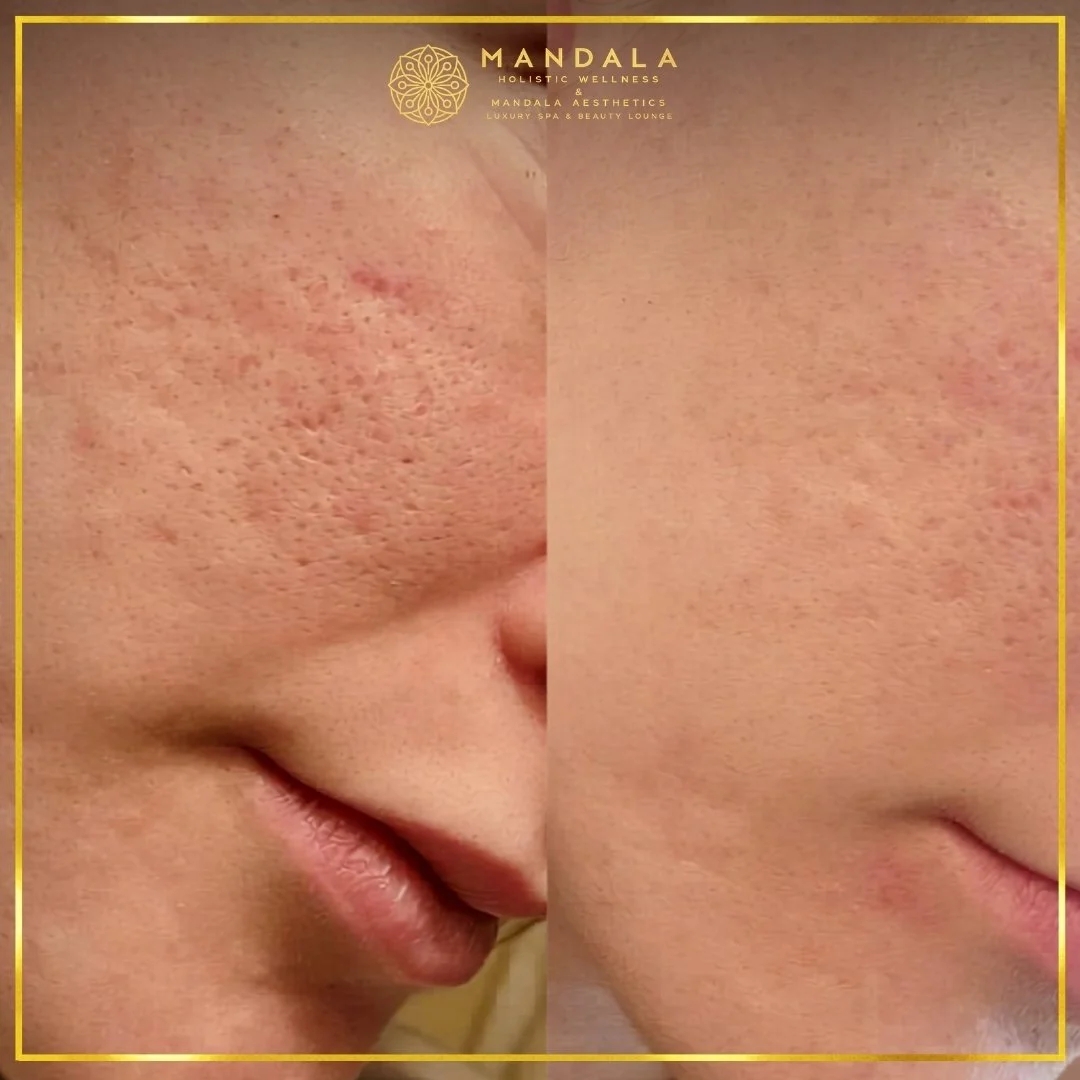 RF Microneedling before and after results showing improved-looking skin texture  and acne scars at Mandala Aesthetics in Preston, Melbourne.