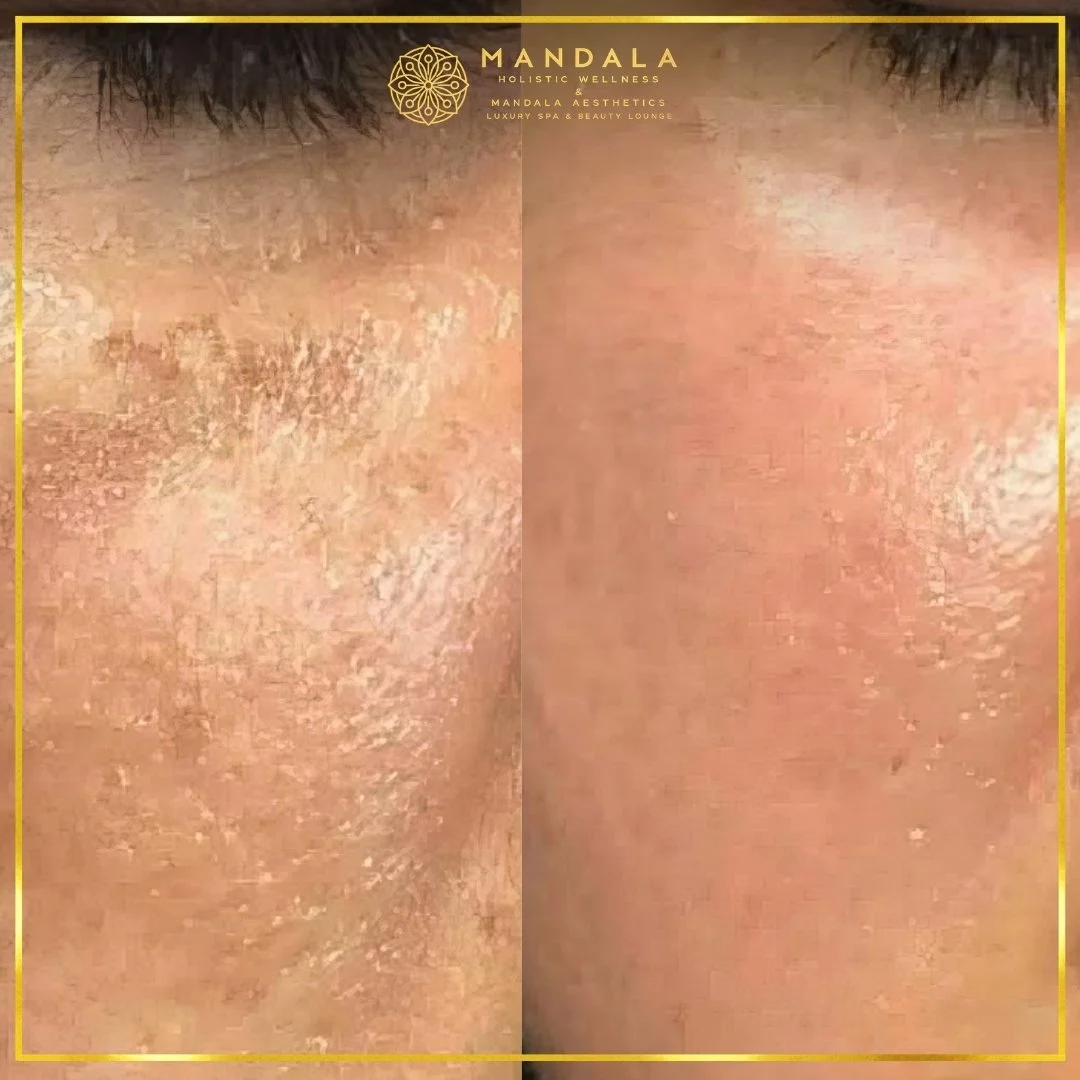 WhiteLab Spot Melanin Removal before and after results showing the appearance of age spots, sun spots , freckles, melasma, pigmentation at Mandala Aesthetics in Preston, Melbourne.
