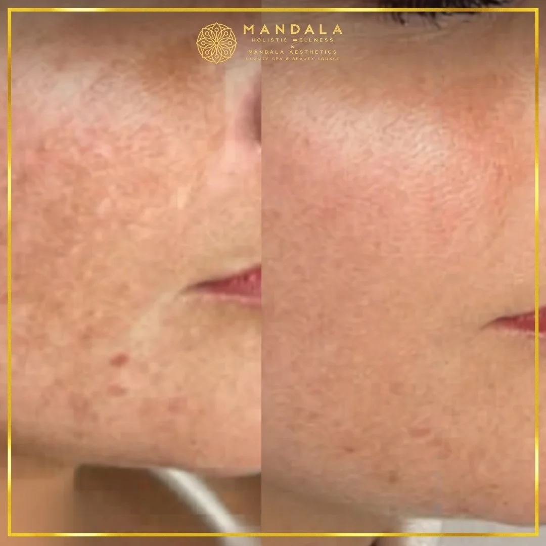 WhiteLab Spot Melanin Removal before and after results showing the appearance of age spots, sun spots , freckles, melasma, pigmentation at Mandala Aesthetics in Preston, Melbourne.