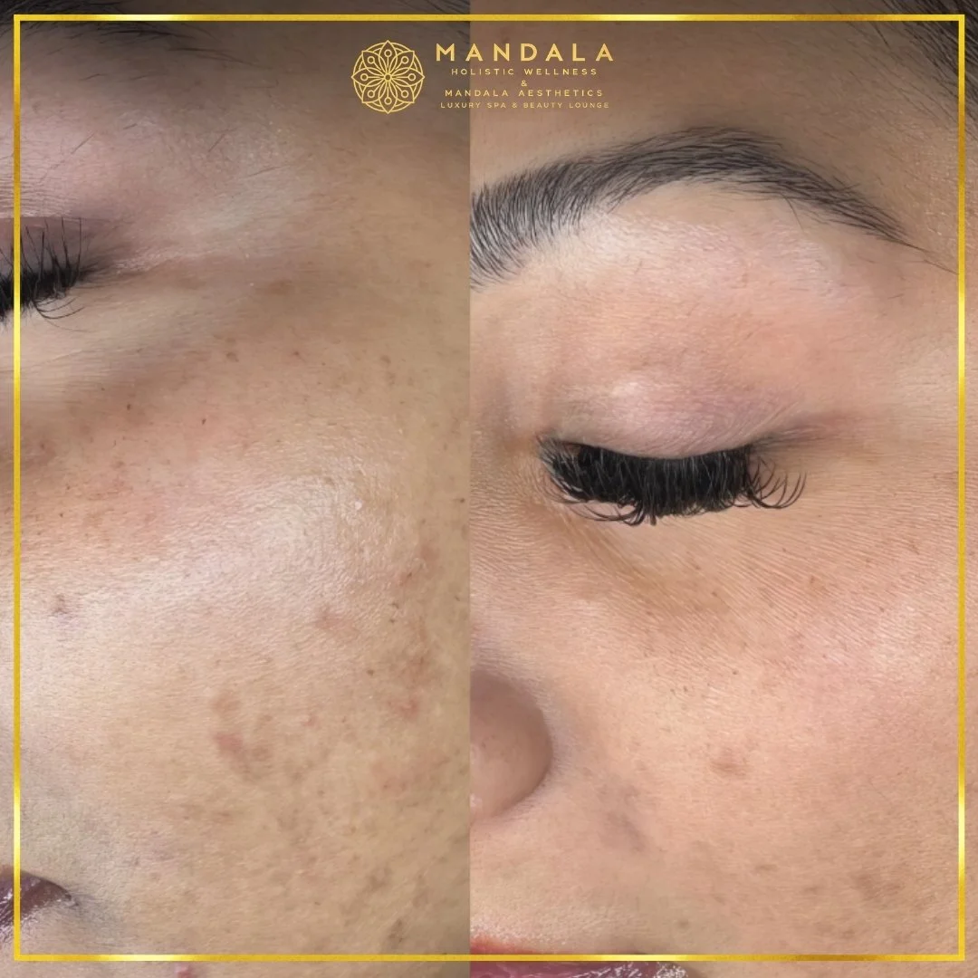 Facial treatment before and after results showing refreshed, hydrated and glowing-looking skin at Mandala Aesthetics in Preston, Melbourne.
