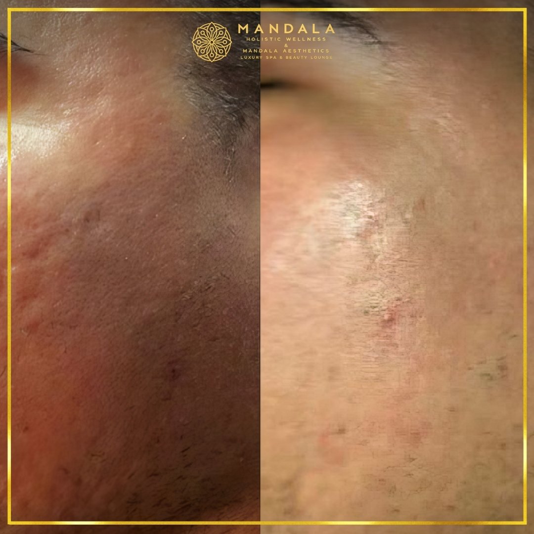 RF Microneedling before and after results showing improved-looking skin texture  and acne scars at Mandala Aesthetics in Preston, Melbourne.