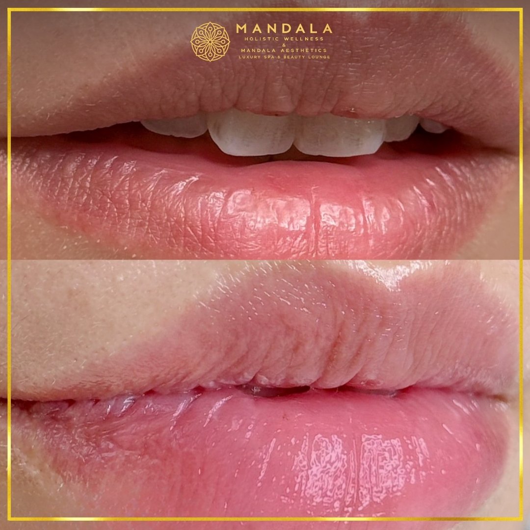 RomaPink Lip Treatment before and after results showing a more even, hydrated lips and naturally pink-looking lip tone at Mandala Aesthetics in Preston, Melbourne.