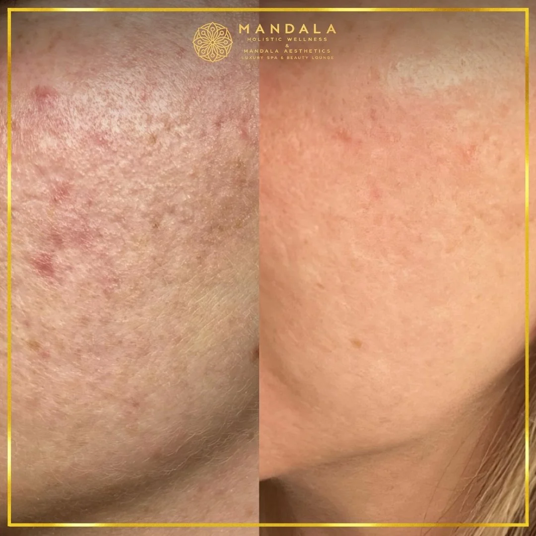 RF Microneedling before and after results showing improved-looking skin texture  and acne scars at Mandala Aesthetics in Preston, Melbourne.