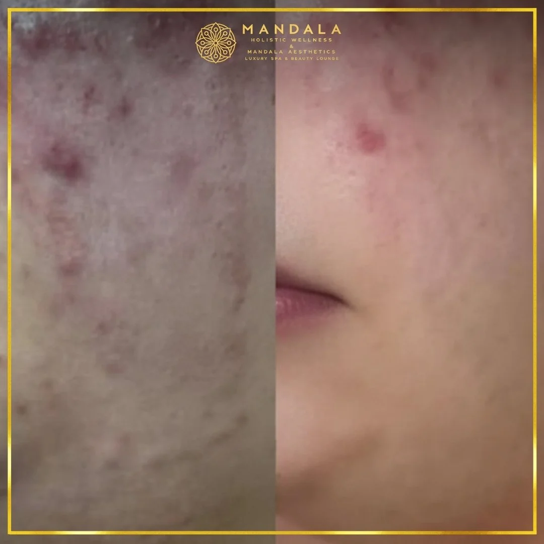 Facial treatment before and after results showing refreshed, hydrated and glowing-looking skin at Mandala Aesthetics in Preston, Melbourne.