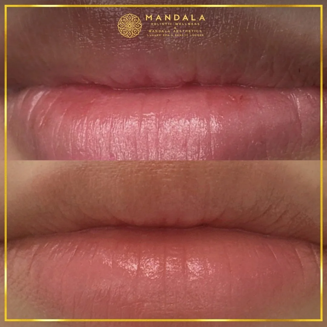 RomaPink Lip Treatment before and after results showing a more even, hydrated lips and naturally pink-looking lip tone at Mandala Aesthetics in Preston, Melbourne.