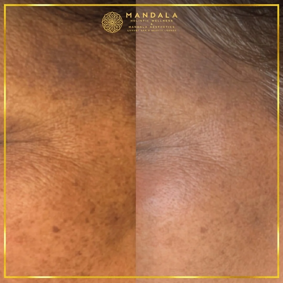 Facial treatment before and after results showing refreshed, hydrated and glowing-looking skin at Mandala Aesthetics in Preston, Melbourne.