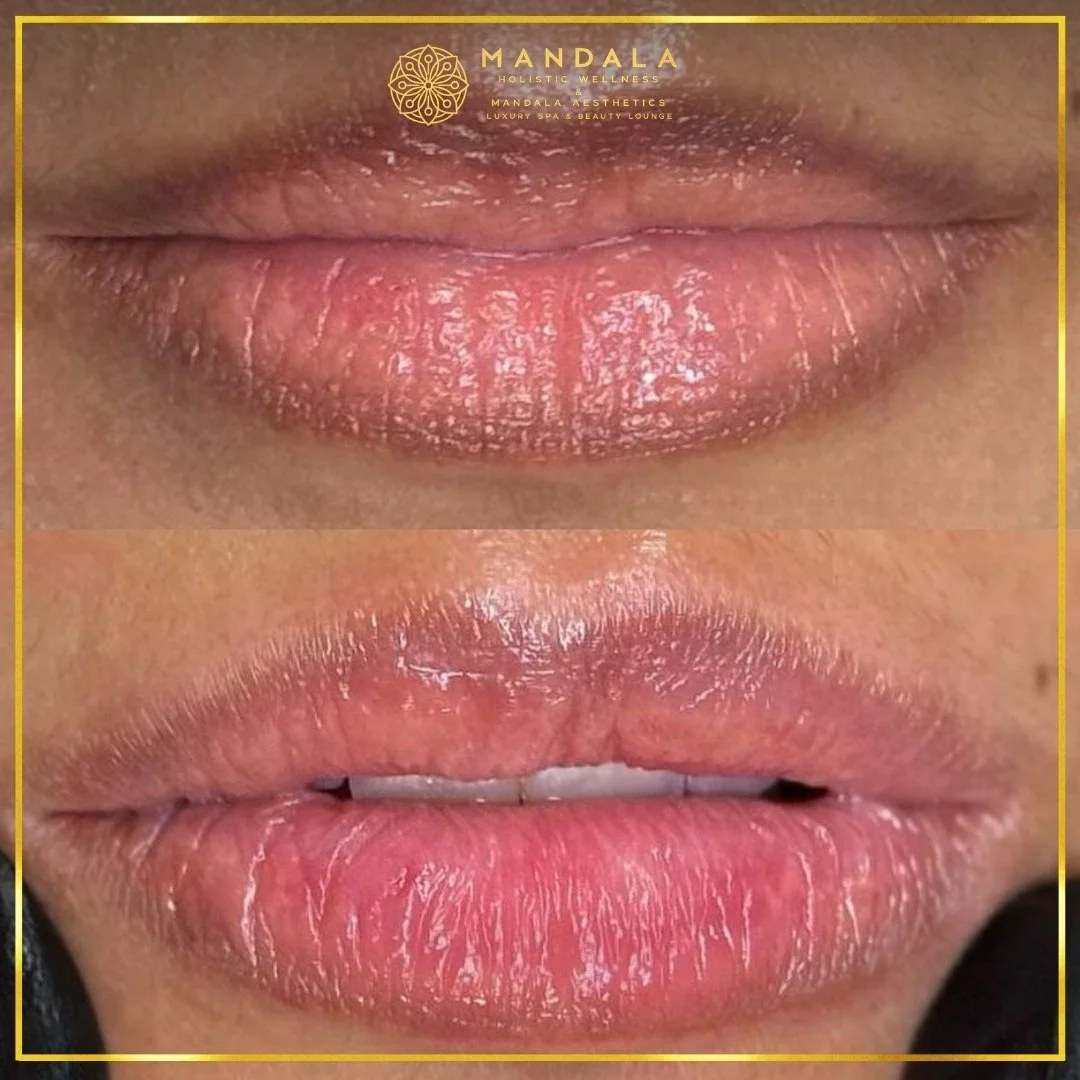 RomaPink Lip Treatment before and after results showing a more even, hydrated lips and naturally pink-looking lip tone at Mandala Aesthetics in Preston, Melbourne.