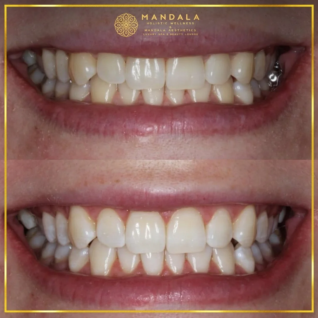 Teeth whitening before and after results showing a visibly white teeth,  brighter-looking smile at Mandala Aesthetics in Preston, Melbourne.