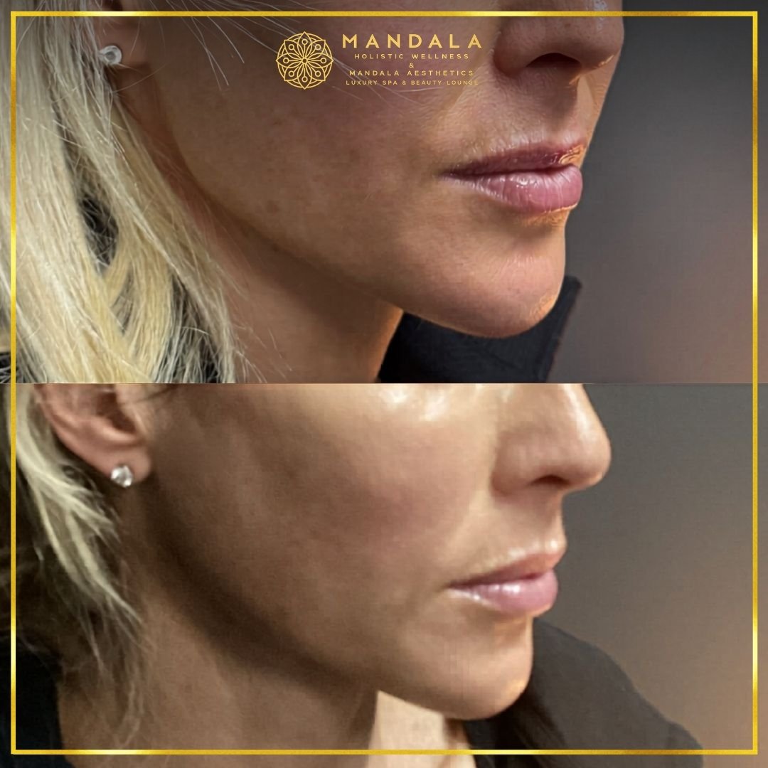 HIFU before and after results showing the lower face, chin and jawline at Mandala Aesthetics in Preston, Melbourne.