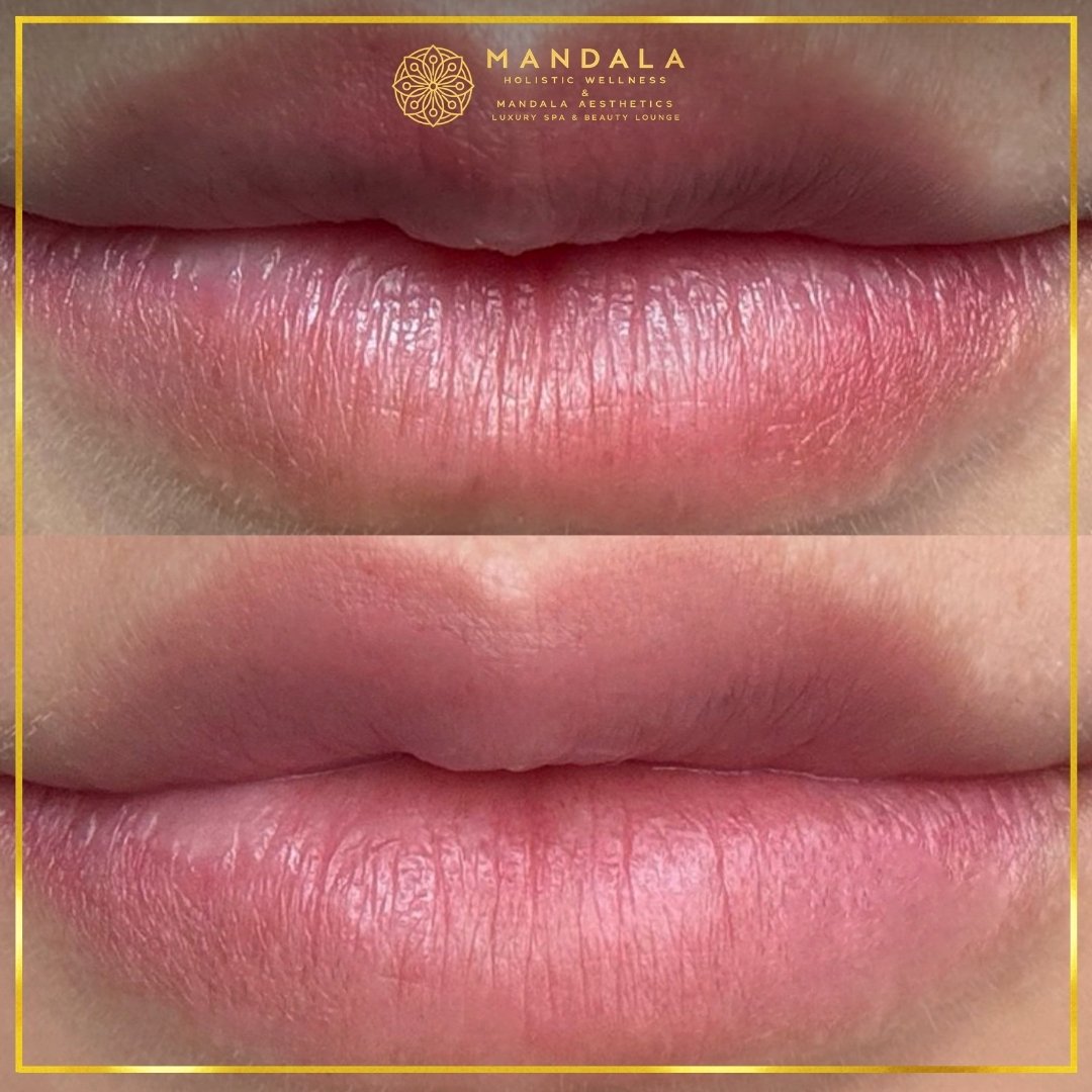 RomaPink Lip Treatment before and after results showing a more even, hydrated lips and naturally pink-looking lip tone at Mandala Aesthetics in Preston, Melbourne.