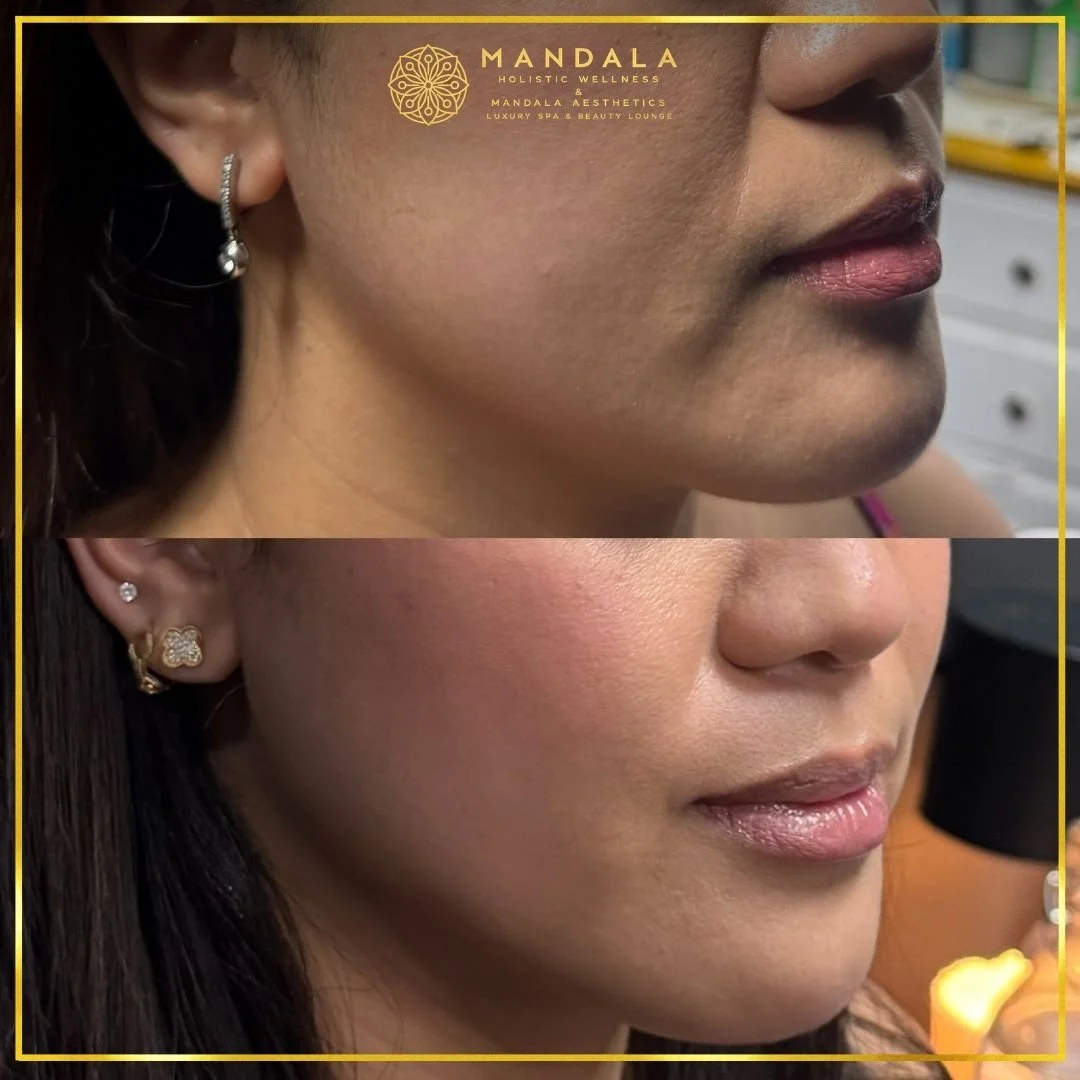 HIFU before and after results showing the lower face, chin and jawline at Mandala Aesthetics in Preston, Melbourne.