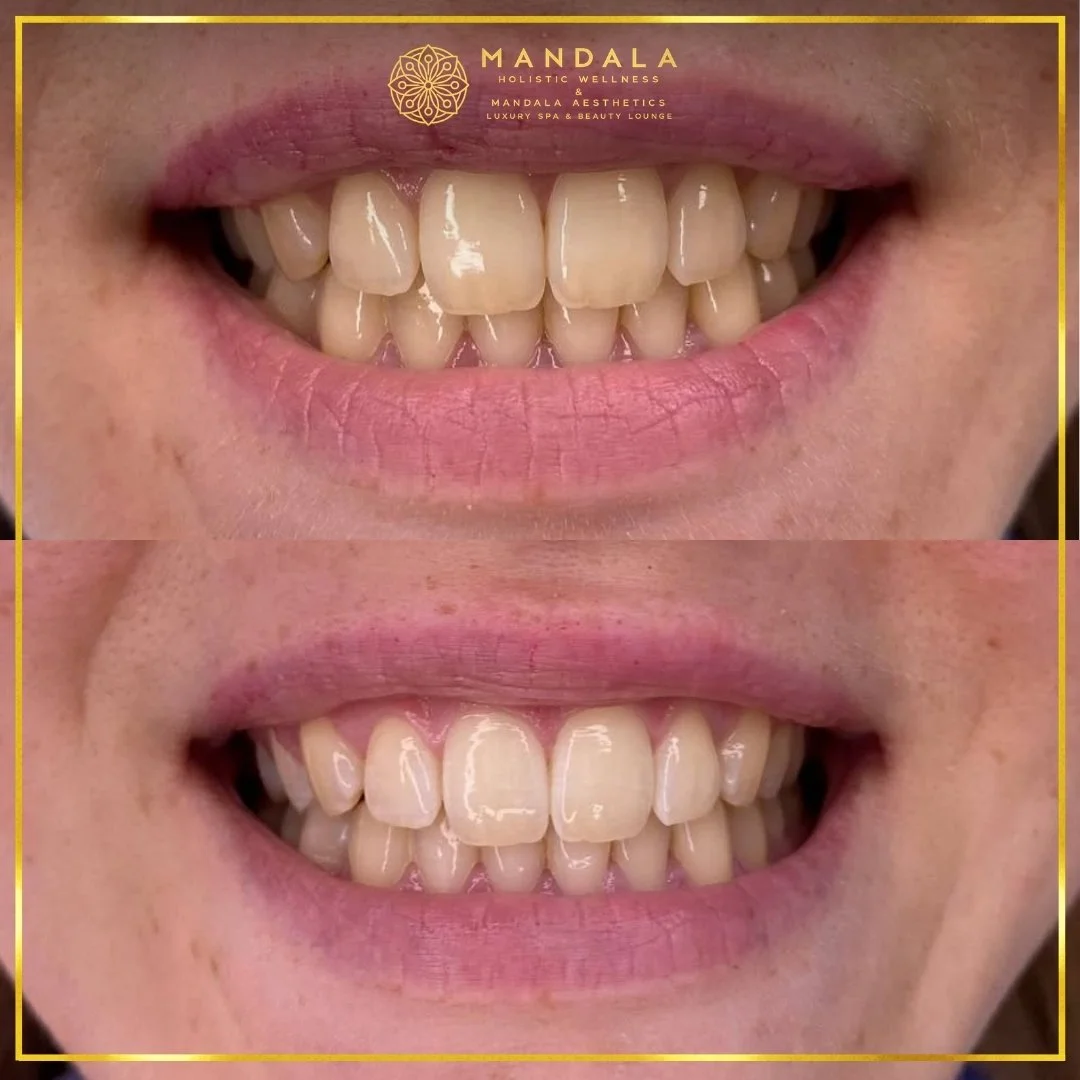 Teeth whitening before and after results showing a visibly white teeth,  brighter-looking smile at Mandala Aesthetics in Preston, Melbourne.