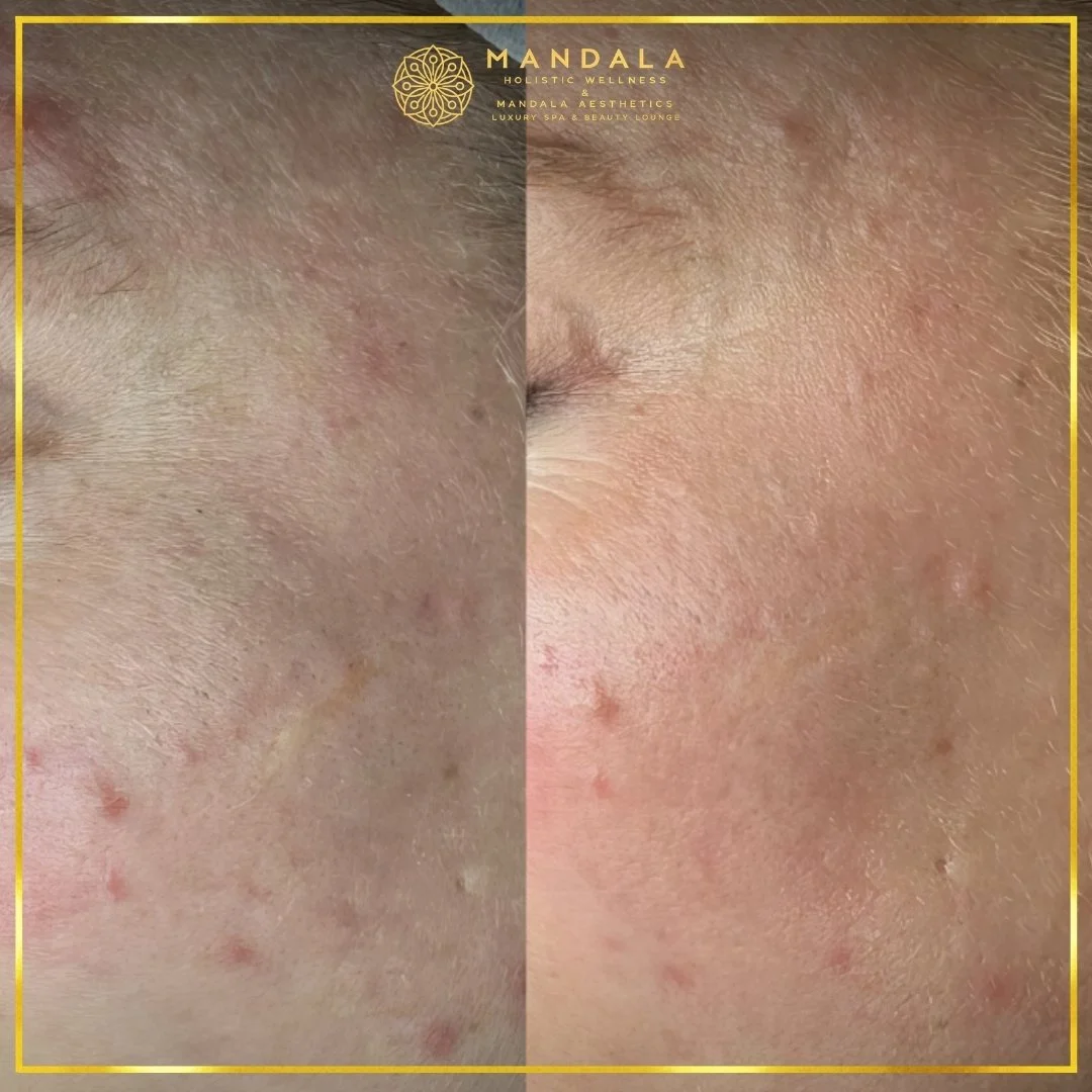Facial treatment before and after results showing refreshed, hydrated and glowing-looking skin at Mandala Aesthetics in Preston, Melbourne.