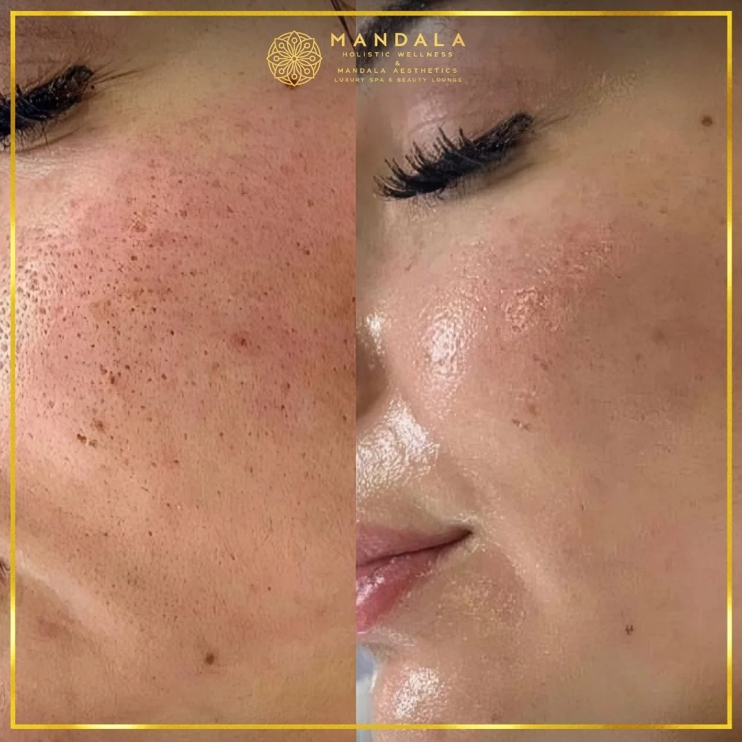 RF Microneedling before and after results showing improved-looking skin texture  and acne scars at Mandala Aesthetics in Preston, Melbourne.