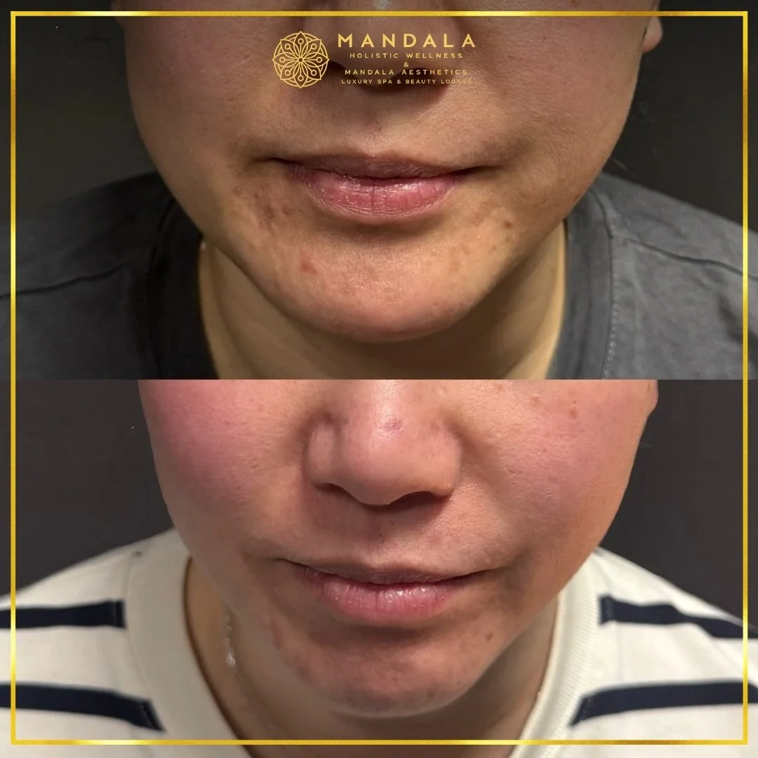 HIFU before and after results showing the lower face, chin and jawline at Mandala Aesthetics in Preston, Melbourne.