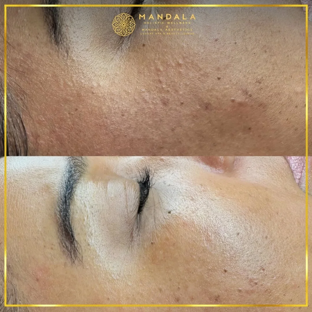 Facial treatment before and after results showing refreshed, hydrated and glowing-looking skin at Mandala Aesthetics in Preston, Melbourne.