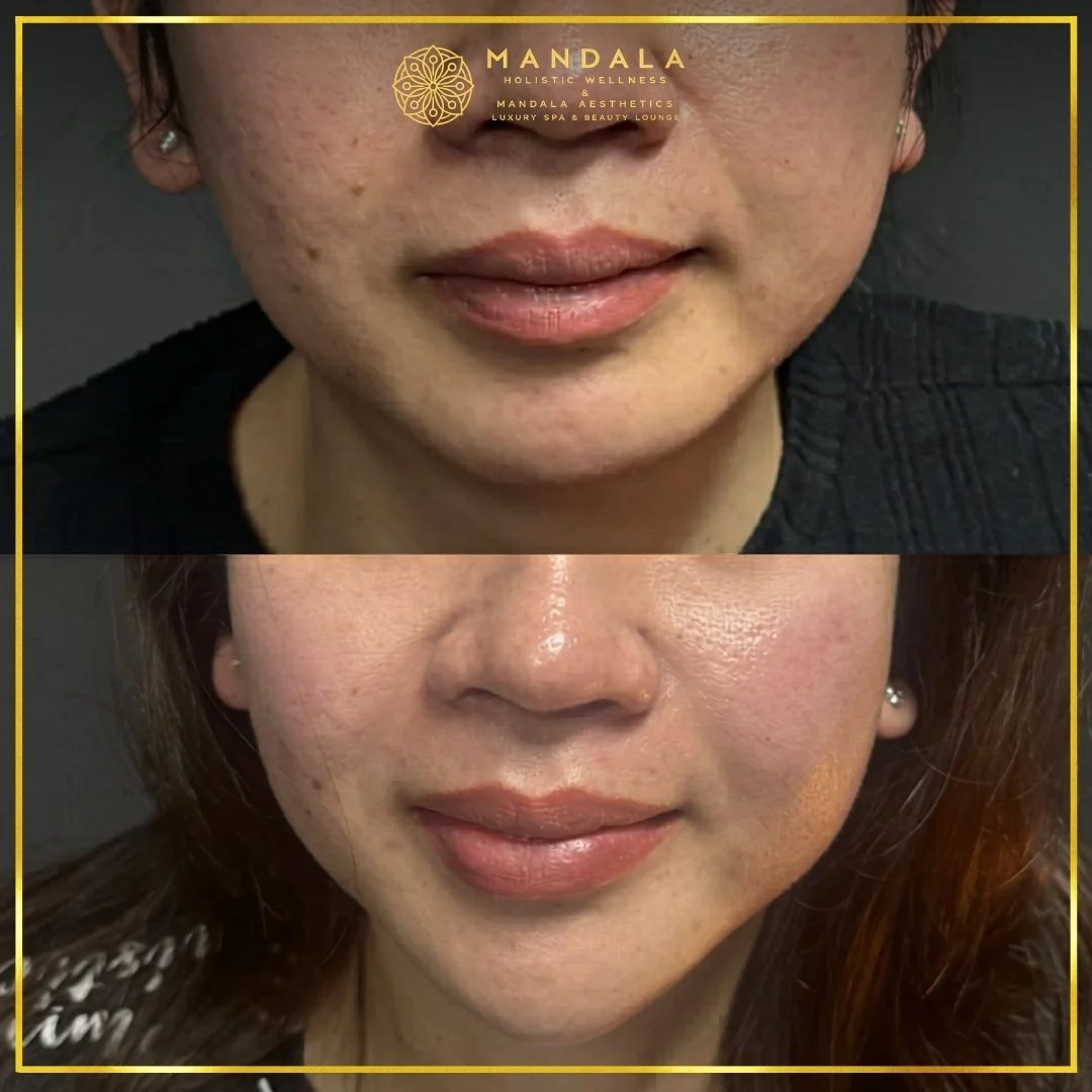 HIFU before and after results showing the lower face, chin and jawline at Mandala Aesthetics in Preston, Melbourne.