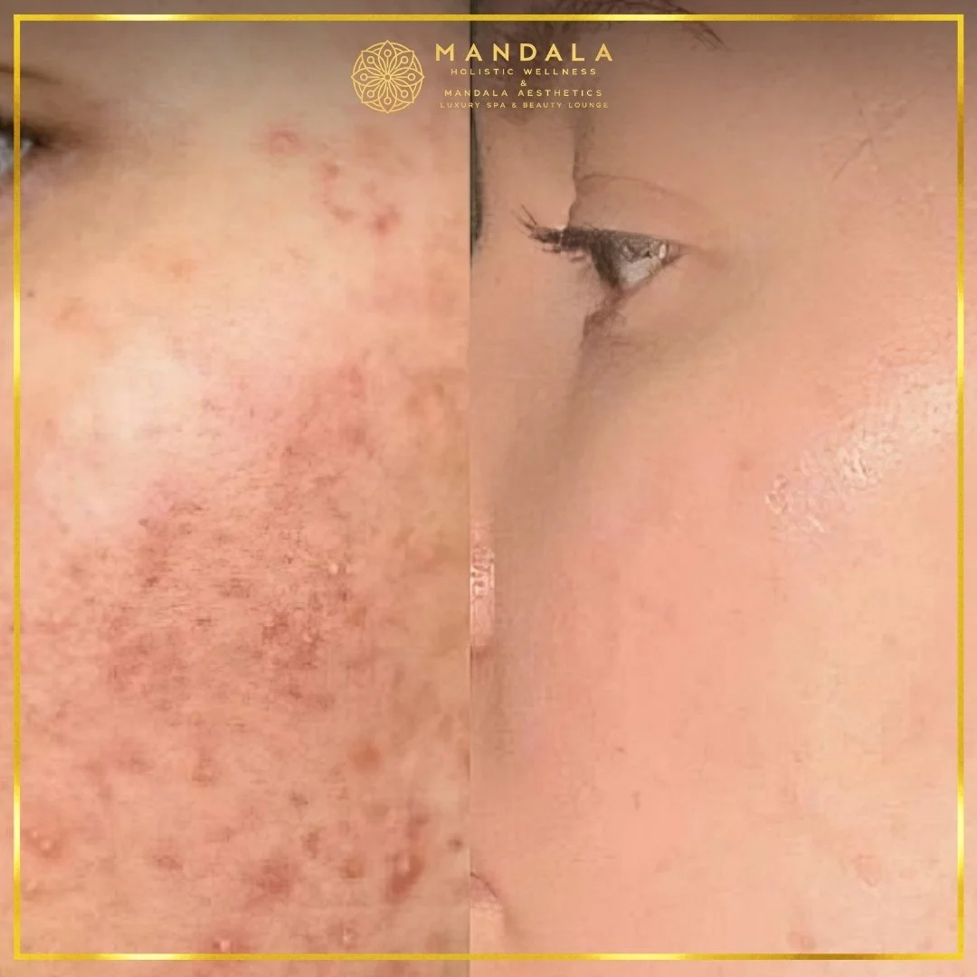 RF Microneedling before and after results showing improved-looking skin texture  and acne scars at Mandala Aesthetics in Preston, Melbourne.