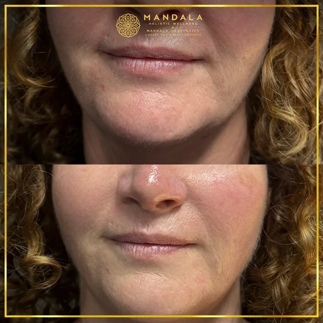 HIFU before and after results showing the lower face, chin and jawline at Mandala Aesthetics in Preston, Melbourne.